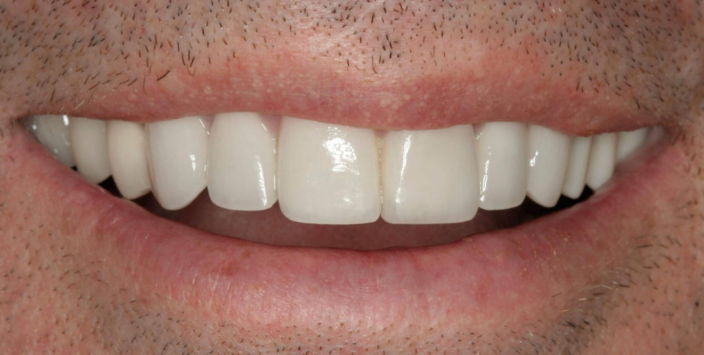 Customizable Dentures Kit with 12 Pieces D214